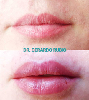 Antes y después aumento labios