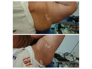 antes y después de mesoterapia