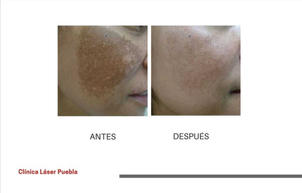 Tipos de manchas de la piel