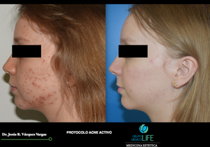 Antes y después de Tratamiento de acné