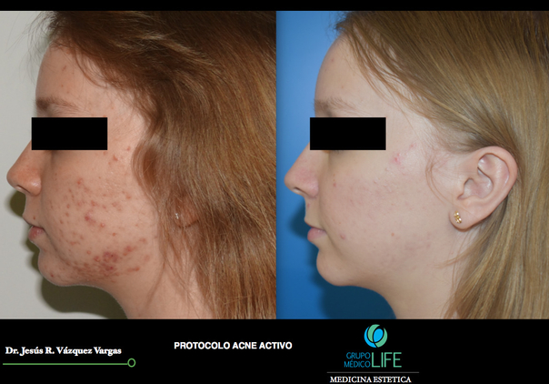  Antes y después de Tratamiento de acné