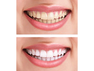 antes y después blanqueamiento dental