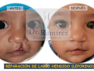 Antes y después labio leporino