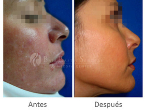 Antes y después. Láser CO2 fraccionado
