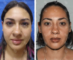 antes y después bolsas bichat