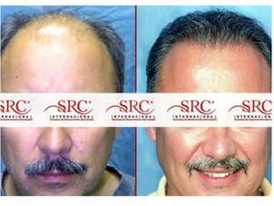 Postoperatorio trasplante de cabello