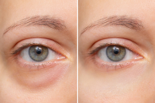 ¿Cuáles son las principales ventajas de realizarse una blefaroplastia sin cirugía?