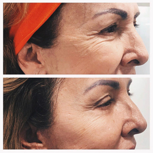 aplicación toxina botulínica