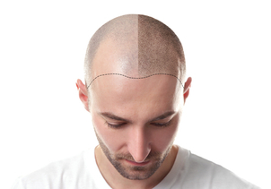 micropigmentación