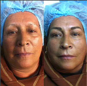 antes y después e micropigmentación