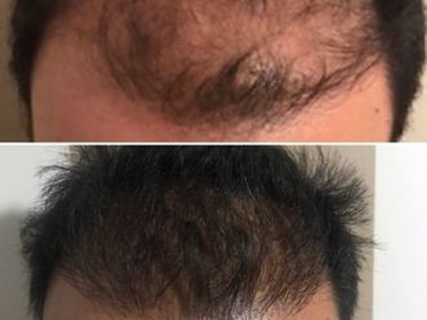 Antes y después tratamiento alopecia