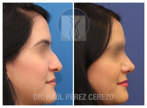 Antes y después de rinoplastia