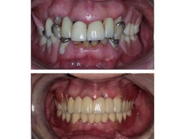 antes y después implantes