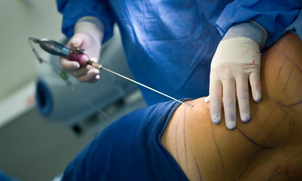 Liposucción tradicionañ