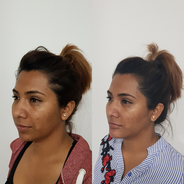 Antes y después de la mentoplastia