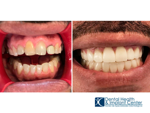 antes y después de ortodoncia