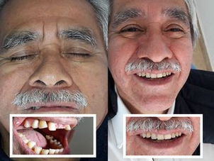 antes y después implantes