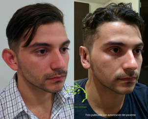 Antes y después Oloplastia