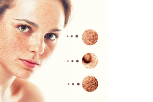 ¿Cuáles son los factores de riesgo en la aparición de un carcinoma basocelular?