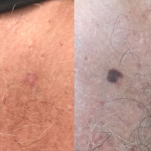 Antes y después de eliminación de verrugas