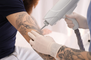 Eliminación de tatuaje
