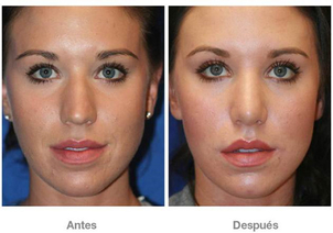 antes y después de microdermoabrasión