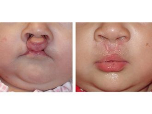 Antes y después paladar hendido