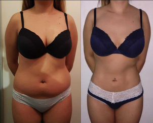 Antes y después cirugía abdominoplastia