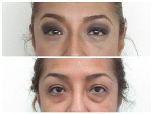 Blefaroplastia sin cirugía