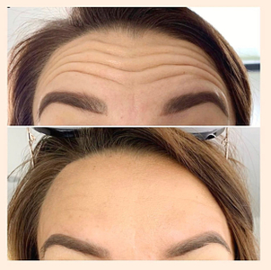 toxina botulínica aplicado