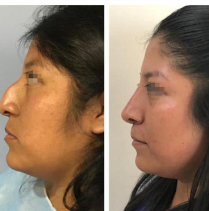 Antes y después de rinoplastia