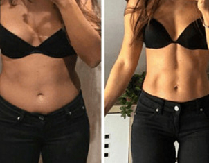 Los resultados finales de la liposucción se observan en meses