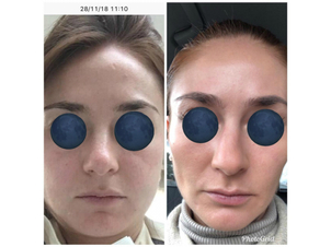 antes y después, bolsas bichat