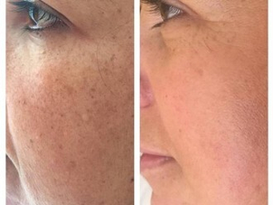 Antes y después peeling