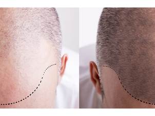 Antes y después de trasplante capilar.