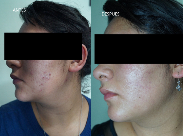 Antes y después del tratamiento de acné