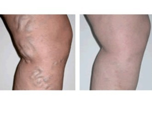 Resultados eliminación várices