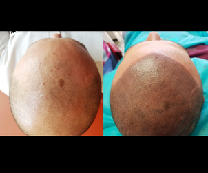 antes y después de micropigmentación