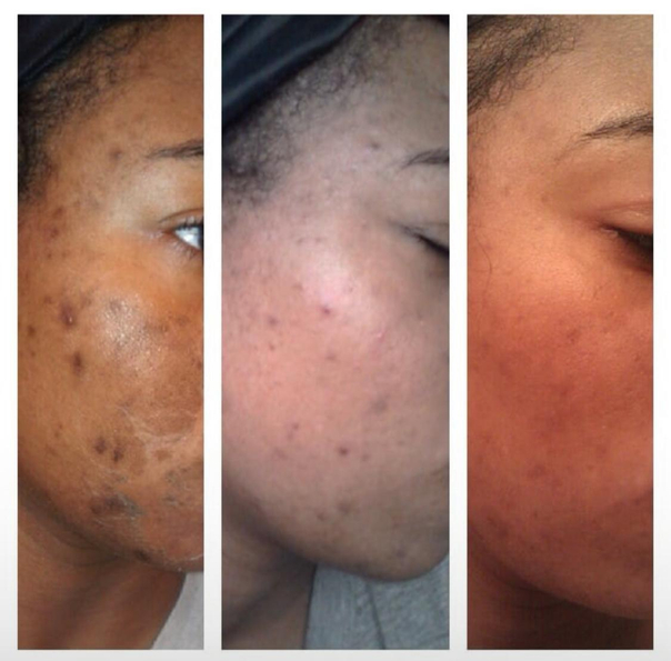 Antes y después de tratamiento de acne