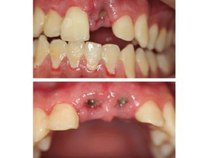 antes y después implantes dentales