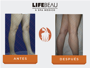 Antes y después aumento chamorros