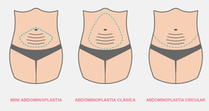 Tipos de abdominoplastia