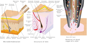 Beneficios microdermoabrasión
