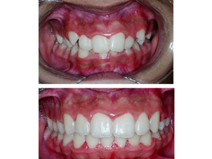 antes y después de ortodoncia