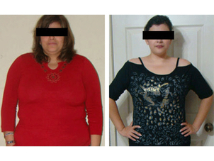 antes y después balón gástrico