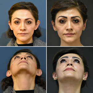 Antes y después de otoplastia