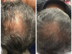 Antes y después alopecia