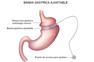 Banda gástrica ajustable