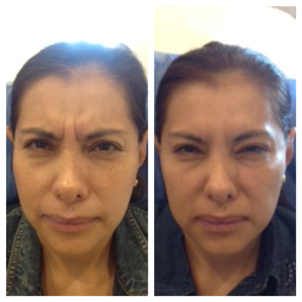 antes y después botox