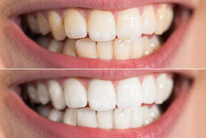 antes y después blanqueamiento dental